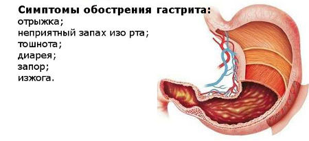 Ознаки загострення гастриту шлунка