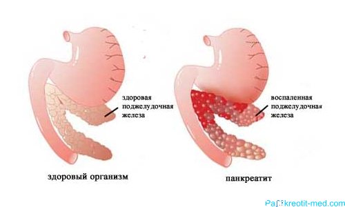 ознаки захворювання підшлункової залози симптоми і лікування