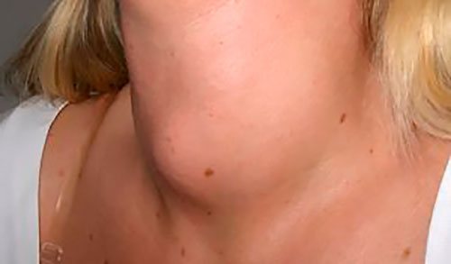 Ознаки зоба щитовидки у жінок фото
