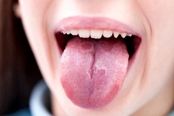 Плями на язиці