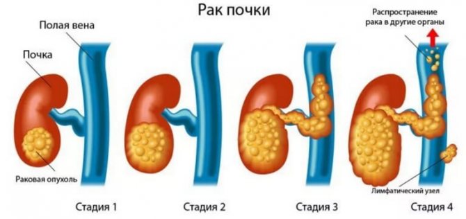 рак нирки