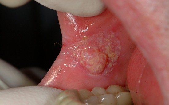 Рак порожніні рота - можлива причина Присмак в роті