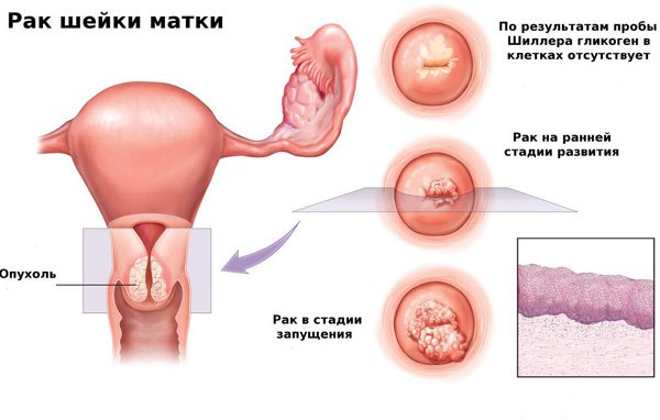 Рак шийки матки