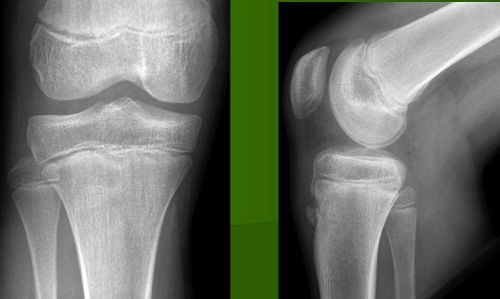 Рентген колінного суглоба