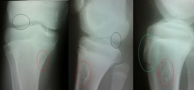 Рентгенографія колінного суглоба при хворобі Осгуда-Шлаттера