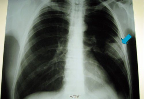 Рентгенограма лівосторонньої пневмонії