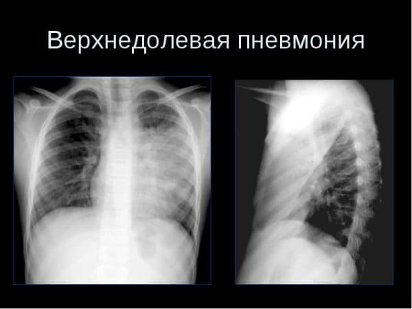 Рентгенологічна картина верхнедолевой пневмонії