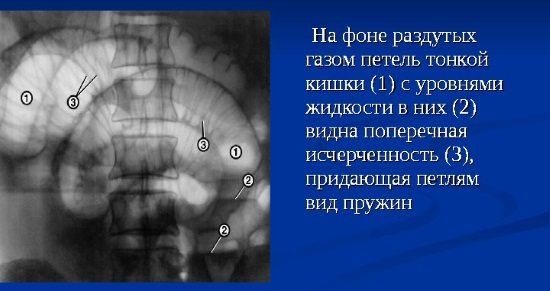 Рентгенівський знімок ОЧП в прямій проекції