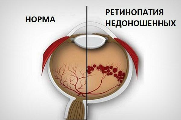 ретинопатія недоношених