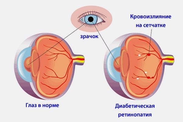 ретинопатія
