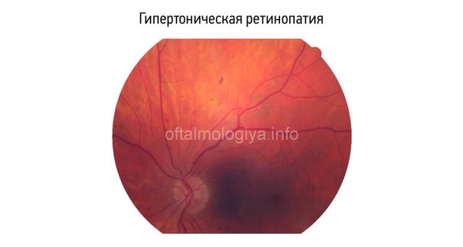 ретинопатія