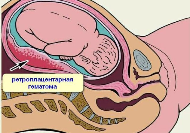 Ретроплацентарна гематома при вагітності