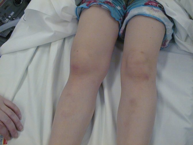 Ревматоїдний артрит коліна