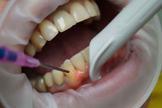 Резекція кореня і лазерне усунення кісти зуба