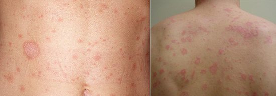 Рожевий лишай Жибера фото сифілітична розеола