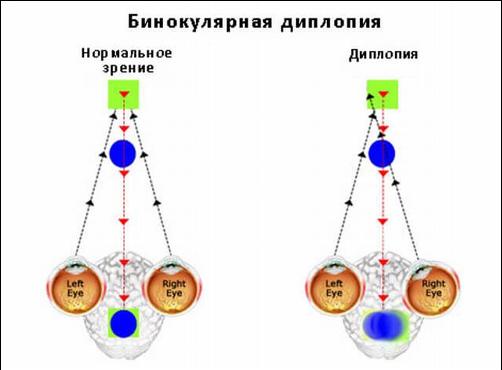Схема бинокулярной диплопии