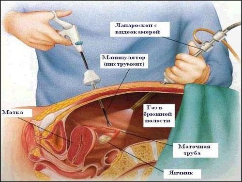 Схема лапороскопіческой операции апоплексії яєчніка