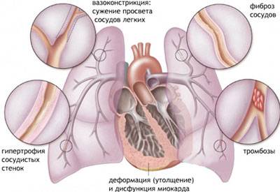Схема легеневого серця