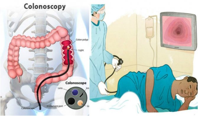 Схематичний малюнок процеса проведення процедури колоноскопії