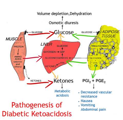 Схематичне зображення ДКА - гострого ускладнення цукрового діабету.