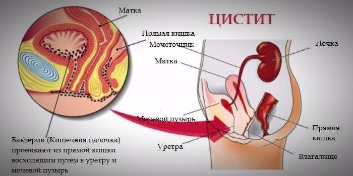 Схематичний опис хвороби