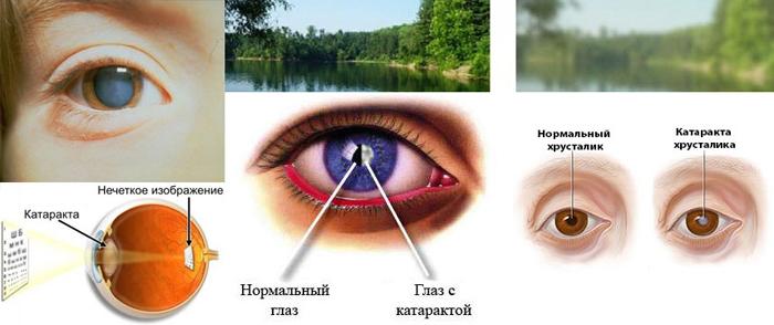 симптоми катаракти