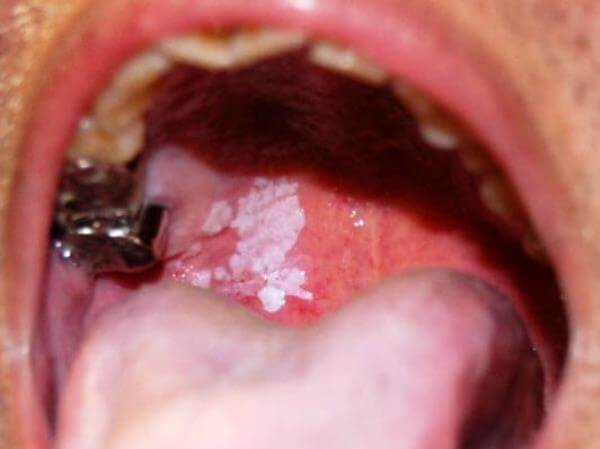 Симптоми раку порожнини рота