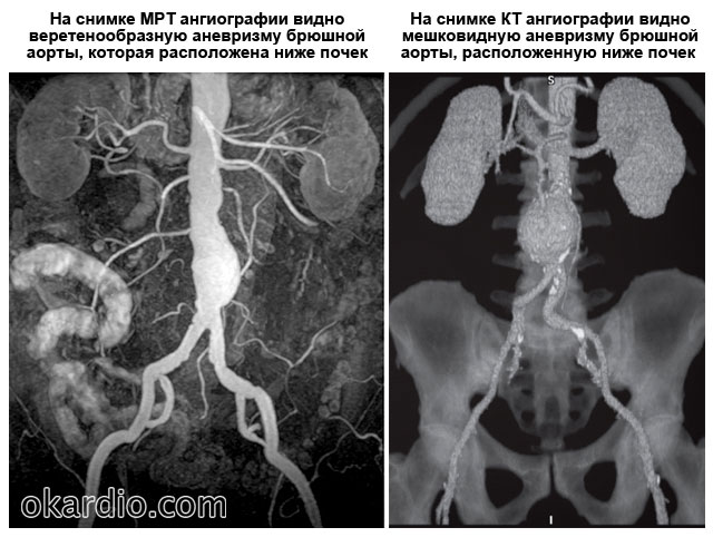 знімки МРТ і КТ аневризми черевної аорти