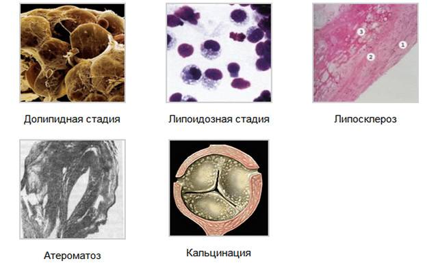 Стадії атеросклерозу: доліпідна, ліпоідозная, ліпосклероз, атероматоз, кальцинація