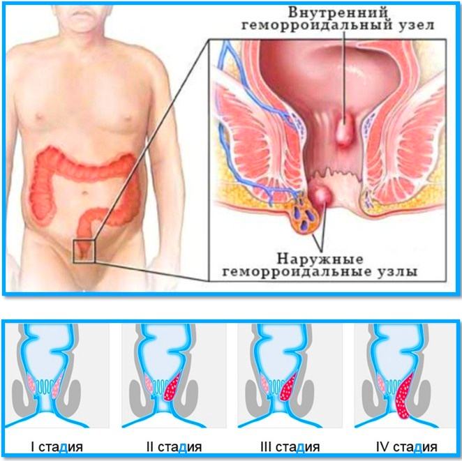 стадії геморою
