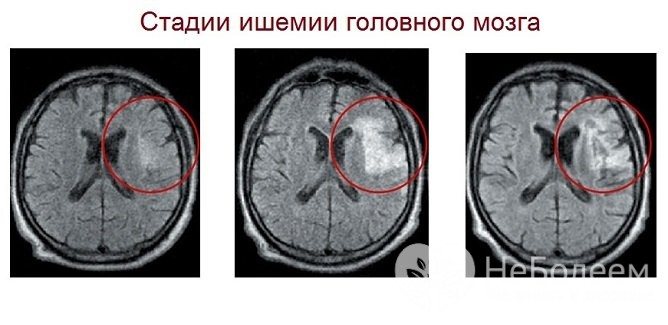 Стадії ішемії головного мозком