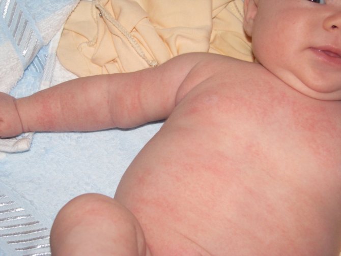 Висип на грудях у дитини може мати інфекційну природу