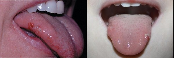 Травми язику внаслідок прікусиванія