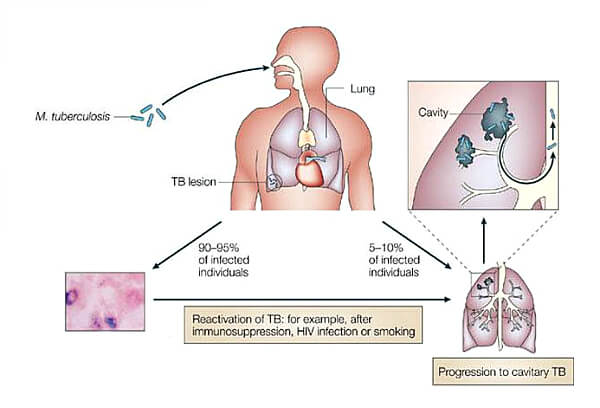 Туберкульоз легень закритої форми