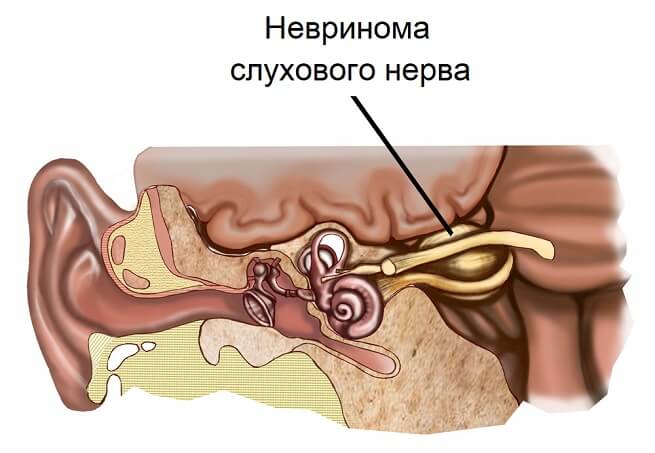 видалення неврином слухового нерва