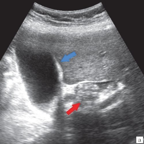 УЗ-картина холедохолитиаза - збільшений жовчний міхур (синя стрілка), конкременти загальної жовчної протоки (червона стрілка)