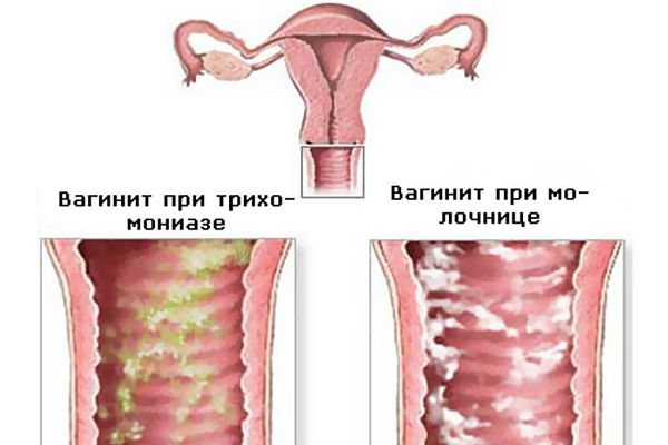 вагініт
