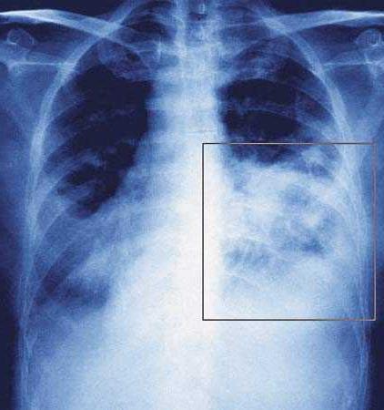 запалення легенів у дитини 2 років симптоми і перші ознаки