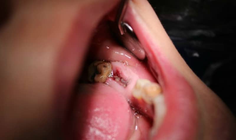Запаленою лунки корінного зуба