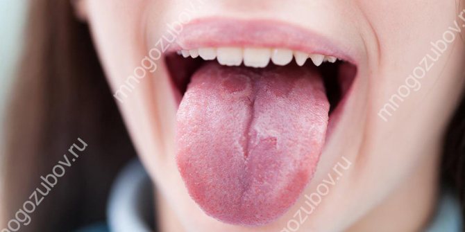 Можлива травма поверхні слизової мови