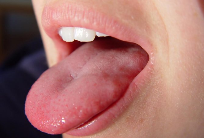 Язик поколює в особах з висунутим язиком.