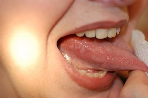 Язик збоку