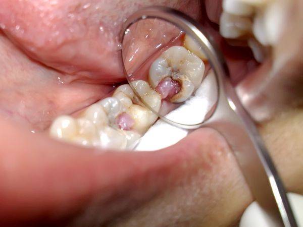 захворювання зуба