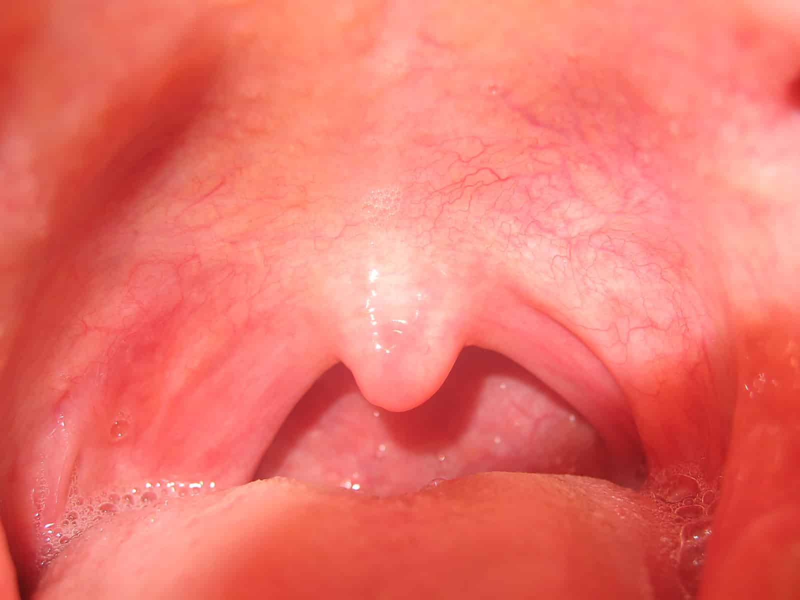 Здорові мигдалини в горлі: як виглядають?