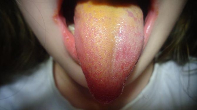 Жовтий наліт на язиці що робити